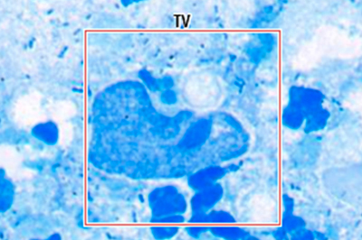 Trichomonas vaginalis